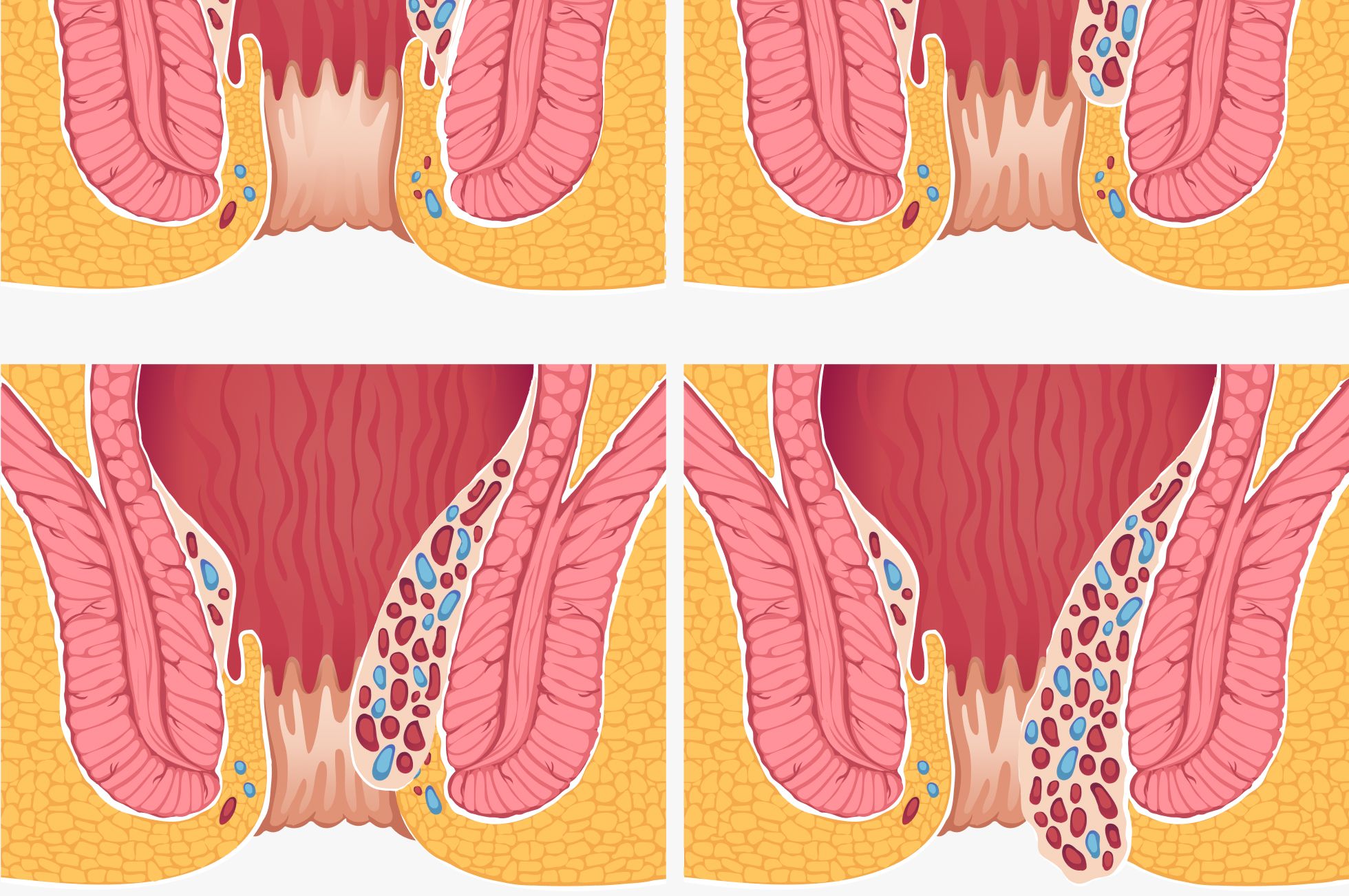 Hämorrhoiden Grad 1 bis 4 im Querschnitt: von leicht vergrößerten Hämorrhoidalpolstern bis zum dauerhaften Vorfall aus dem After