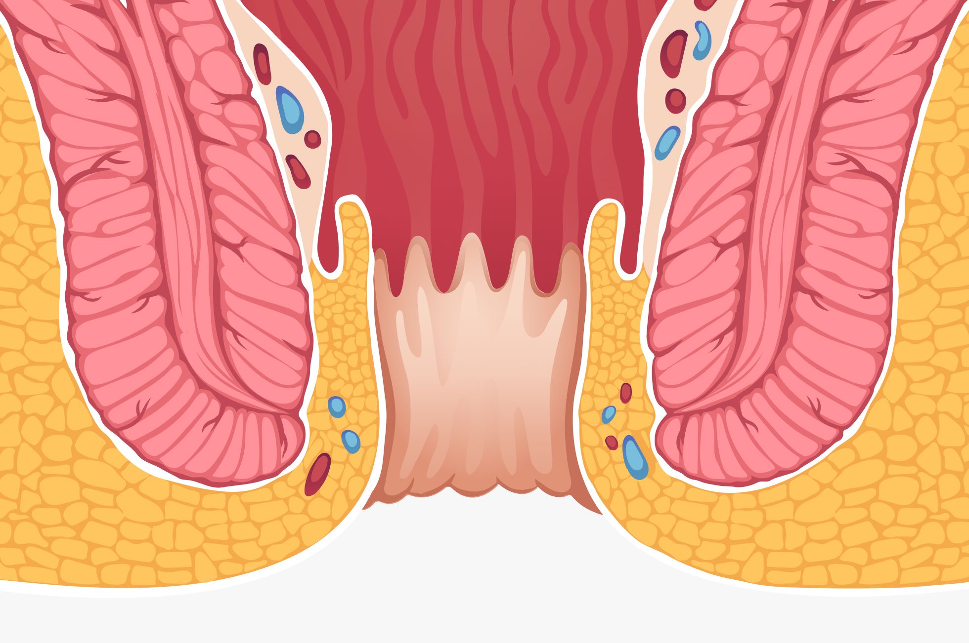 Querschnitt des Analkanals mit normaler Anatomie: Enddarm, Hämorrhoidalpolster, Schließmuskel und Afterhaut
