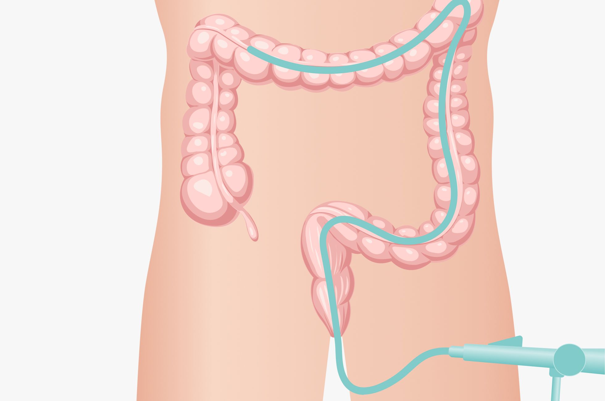 Rektosigmoidoskopie: Endoskop wird über den After in Mastdarm und Sigma eingeführt, Illustration des Dickdarms im Unterbauch