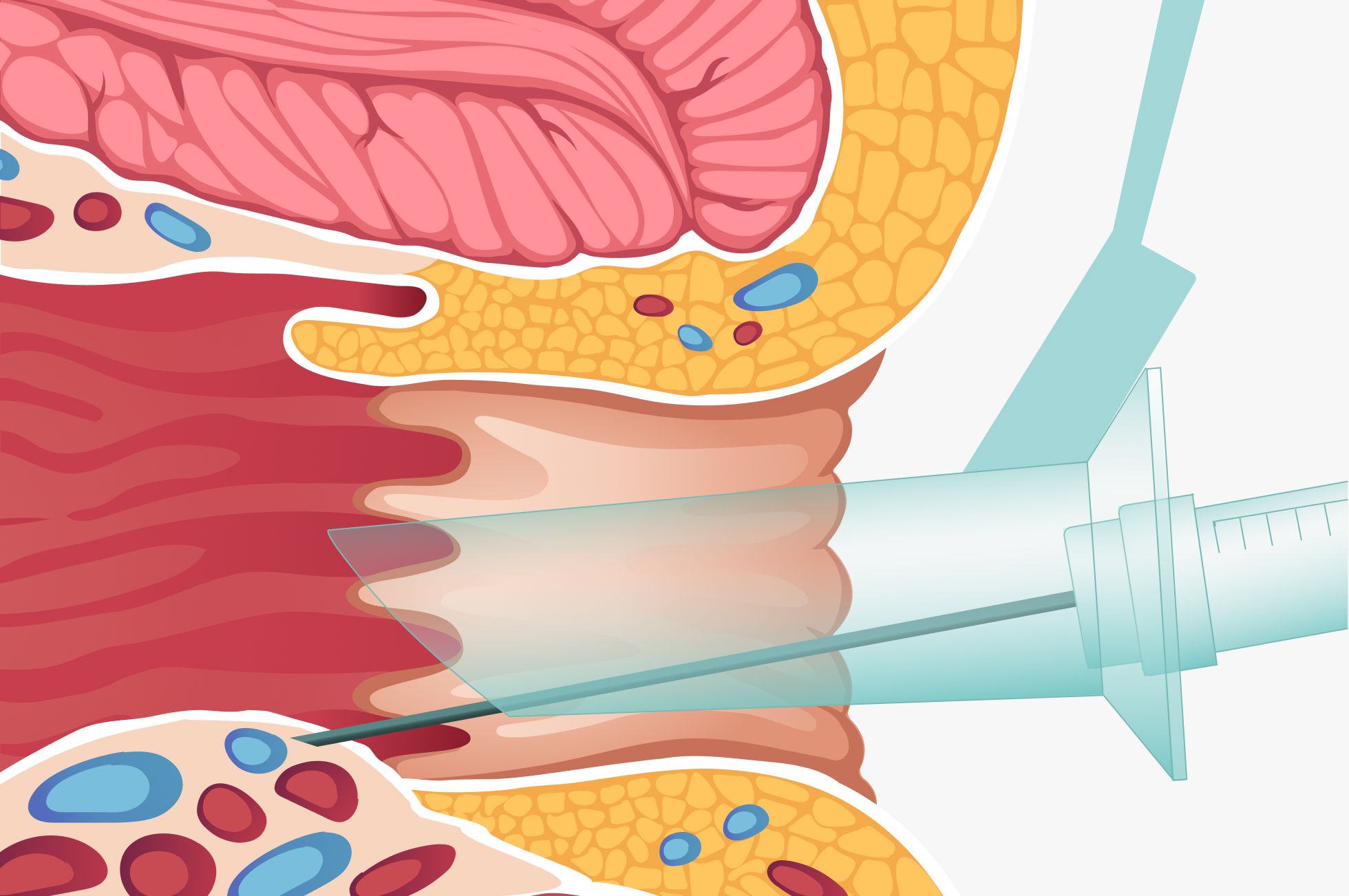 Sklerosierung von Hämorrhoiden: Querschnitt des Analkanals, eine Spritze injiziert Verödungsmittel in das vergrößerte Hämorrhoidalpolster